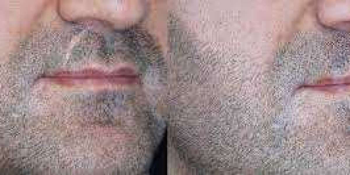 Beard Micropigmentation Cost