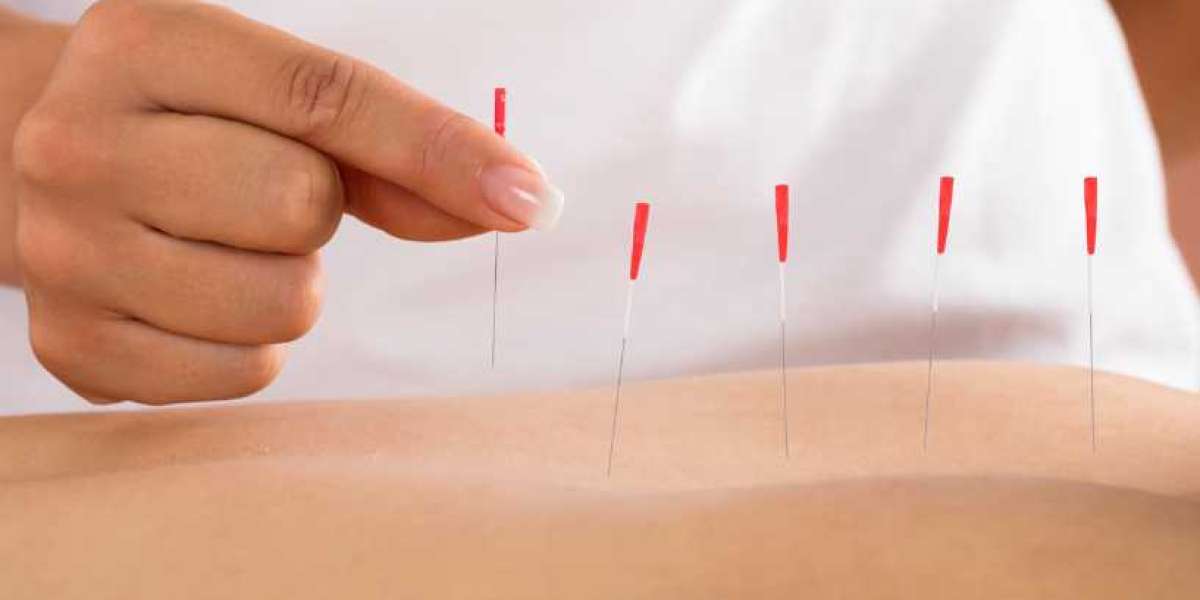 How to Get the Most Out of Your Dry Needling Therapist in Gurgaon?