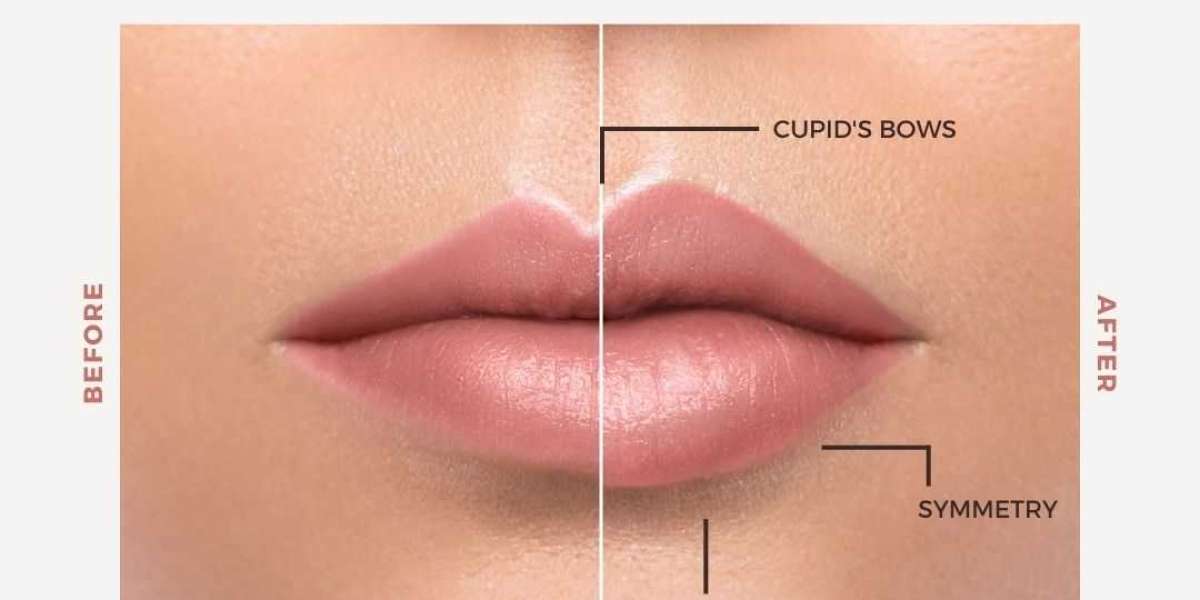 Perfect Your Pout with Our Skilled Lip Filler Procedures