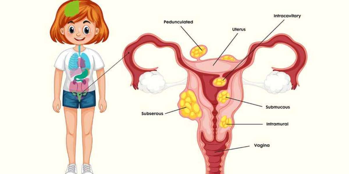 Comprehensive Guide to Uterine Fibroids Treatment | Flowcare